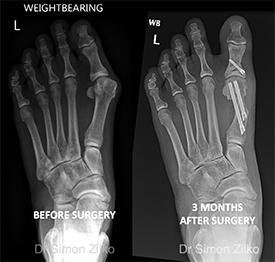 bunionectomy x ray